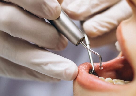 Softdent diş kliniğinde 20'lik diş çekimi işlemi görseli