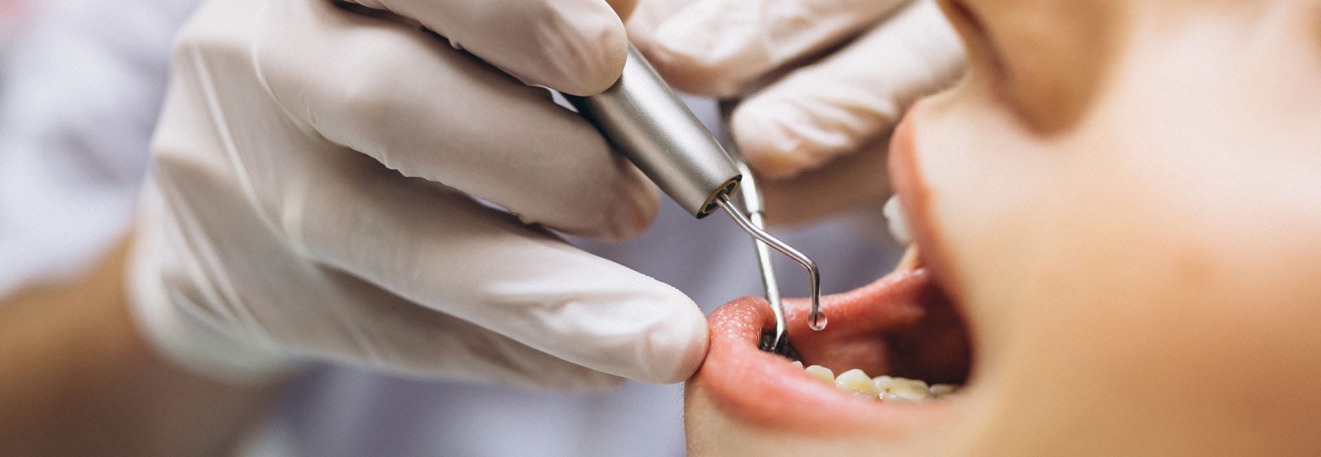 Softdent diş kliniğinde 20'lik diş çekimi işlemi görseli