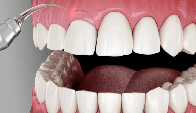 Pembe Estetik, diş etlerinin doğal, simetrik ve estetik bir görünüme kavuşmasını sağlayan bir diş eti estetiği yöntemidir ve gülüş tasarımının önemli bir parçasıdır. Gummy smile (fazla görünen diş eti), asimetri veya diş eti çizgisinin uyumsuz olduğu durumlarda tercih edilen bu yöntem, lazer veya cerrahi tekniklerle uygulanabilir. Lazerle yapılan işlemler, minimal invaziv özellikleri sayesinde hızlı iyileşme sunarken, cerrahi yöntemler daha karmaşık durumlarda kullanılır. Pembe estetik, dişlerin estetiğini artırırken diş eti sağlığını koruyarak genel ağız sağlığına katkı sağlar. Sağlıklı bir gülüşle sosyal özgüveni artıran bu tedavi, uygun bakım ve düzenli kontrollerle uzun vadeli sonuçlar sunar.