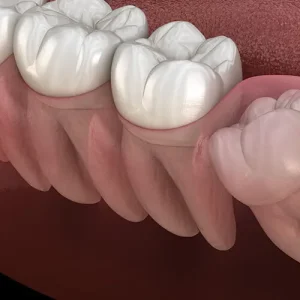 20'lik gömülü diş sıkıştırması